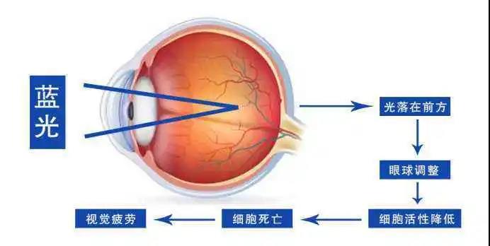 宅家1個月近視飆升200度？這個護(hù)眼方法別忽略！